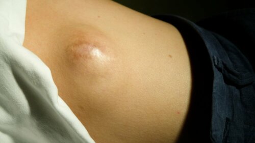 Lipoma