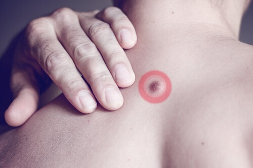 Noduli di grasso sulla schiena: cosa sono?