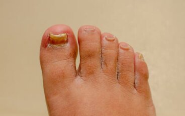 Onicomicosi di mani e piedi: quali rimedi?