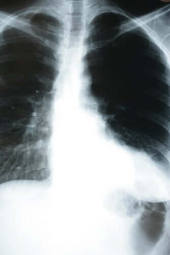 Polmonite silenziosa, radiografia