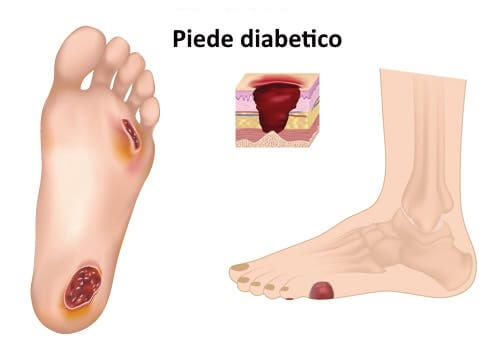 Piede diabetico