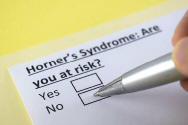 La sindrome di Horner: di cosa si tratta?