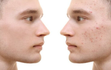 Curcuma per l'acne: benefici e applicazione