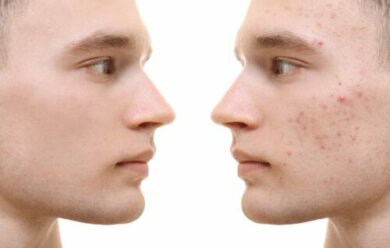 Curcuma per l'acne: benefici e applicazione