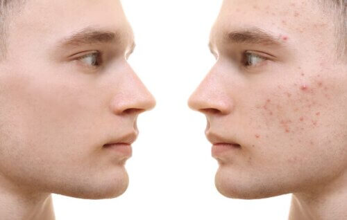 Curcuma per l'acne: benefici e applicazione