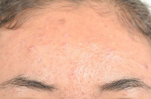 Rimedi naturali contro la dermatite seborroica