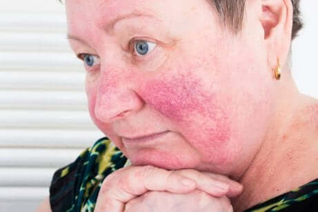 Donna con acne rosacea sulle guance.