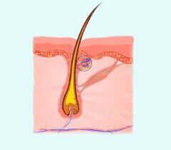 Epitelioma calcifico di Malherbe: che cos'è?