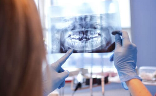 Gangrena del cavo orale