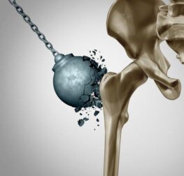 Conseguenze dell'osteoporosi dopo la menopausa