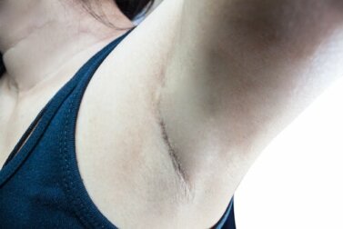 Linfonodo sentinella: cos'è e perché è importante?