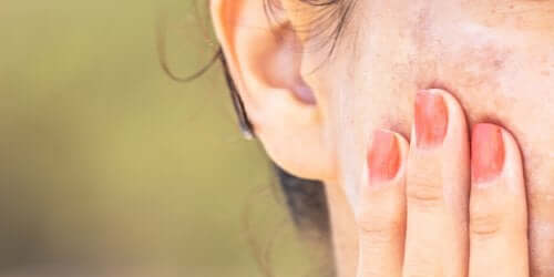 Melasma sulla guancia