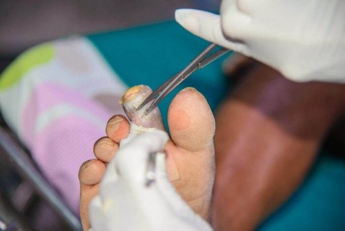 La gangrena: cos'è e da cosa è causata