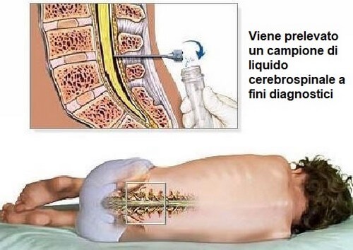 Descrizione della puntura lombare