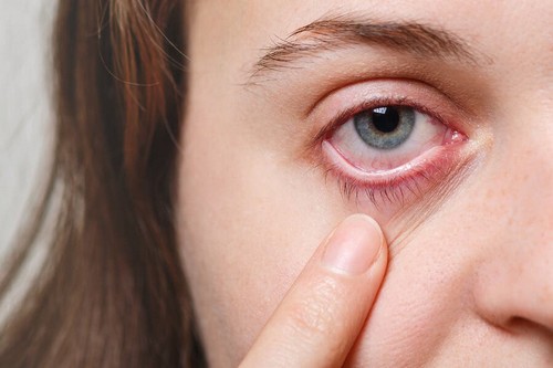 Infezione oculare: rimedi per calmare i sintomi