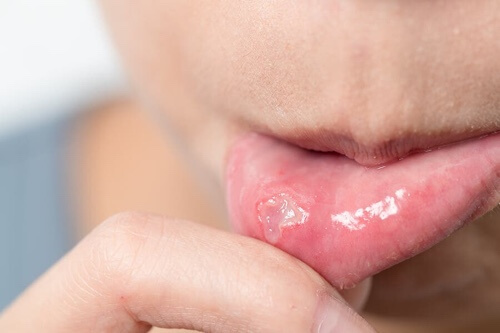 Curare velocemente le afte della bocca con 5 rimedi