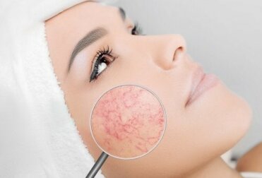 Acne rosacea: cosmetici e abitudini da evitare