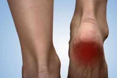 Rimedi per la spina calcaneare da preparare in casa