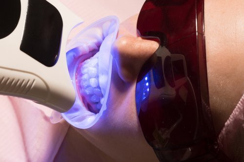 Sbiancamento dei denti con laser