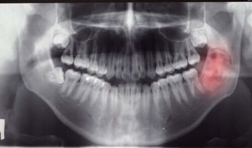 Radiografia di tumori alla mandibola.