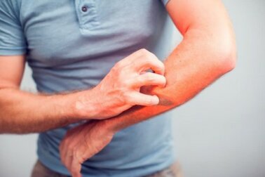 Calmare il prurito e l'irritazione in modo naturale