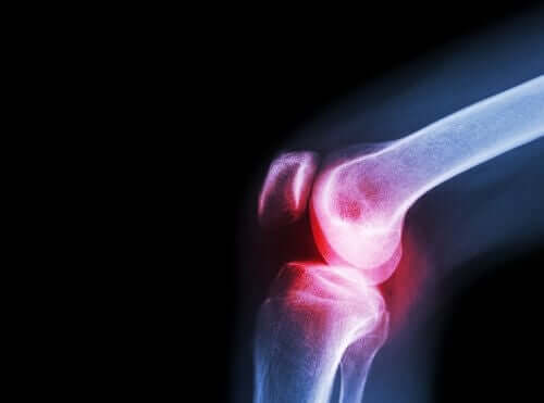 Artrite nel ginocchio a causa del lupus eritematoso.