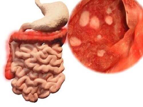 Batterio presente nell'intestino causato da intossicazione alimentare.