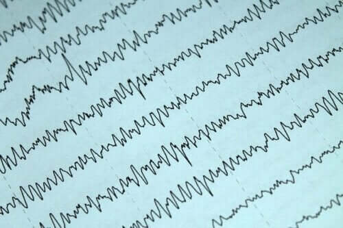 Elettrocardiogramma per diagnosticare l'epilessia.