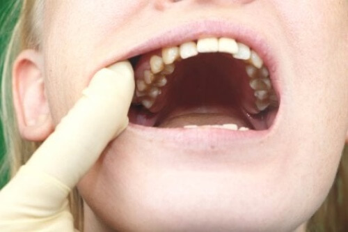Visita dal dentista per individuare i batteri che provocano le carie ai denti.