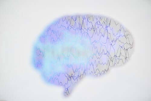 Immagine del cervello affetto da epilessia.