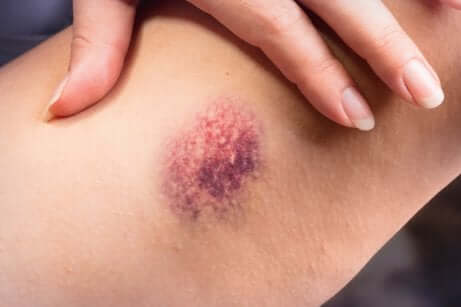 La comparsa di un ematoma è tra sintomi di una tromboflebite superficiale.