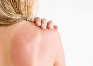 Eritema solare: prevenzione e trattamento