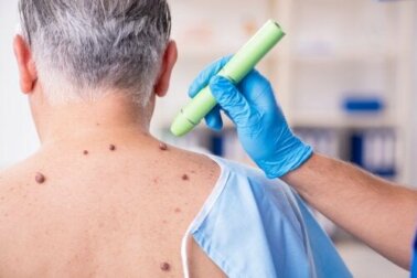 Le verruche sanguinano in alcuni casi: cosa fare?