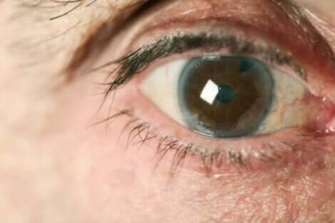 Paziente con glaucoma.