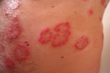 Il lupus eritematoso: la malattia dalle ali di farfalla