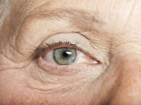 Nevi oculari in una persona dalla carnagione chiara.