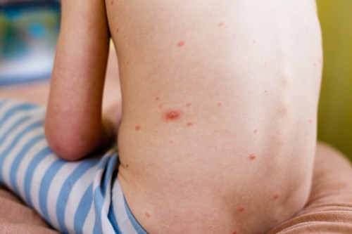 Orticaria nei bambini ed eruzioni sulla schiena.