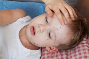 Orticaria nei bambini: come intervenire?
