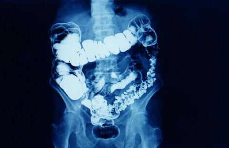 Radiografia dell'intestino.