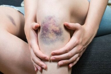 Tromboflebite superficiale: definizione e cause