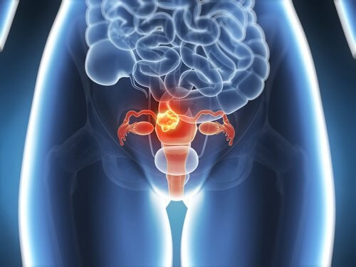 Tumore dello utero diagnosi e trattamento.