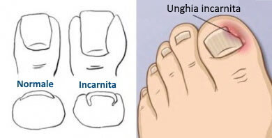 Unghia del piede incarnita.