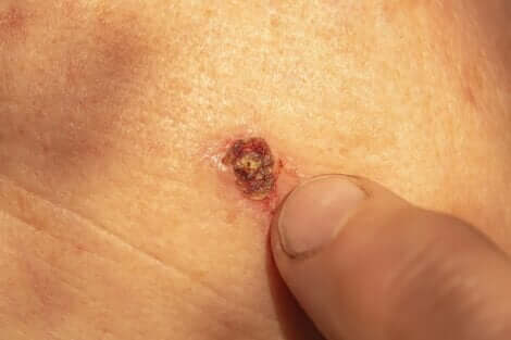 Bisogna chiedere al dermatologo perché le verruche sanguinano.