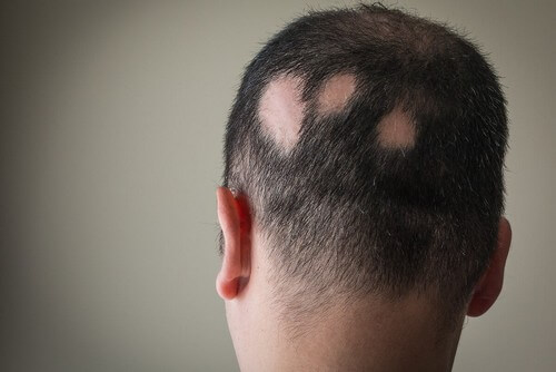 Uomo con alopecia areata.