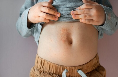 Trattamento della dermatite atopica nel bambino