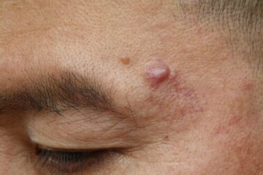 Cisti epidermoidi: cause e possibili trattamenti