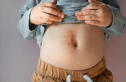 Dermatite atopica nei bambini.