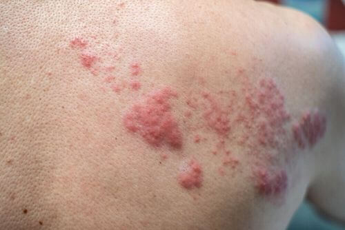 Rash cutaneo da herpes zoster.