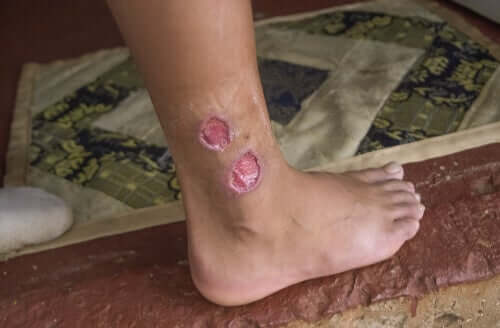 Lesioni da leishmaniosi cutanea.