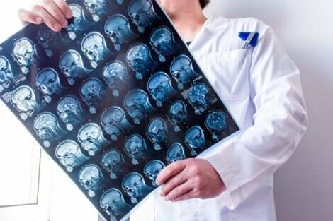 Medico mostra lastre al cervello di paziente con morbo di Parkinson.